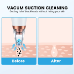 Multi-functional Blackhead Remover Device - Image 3